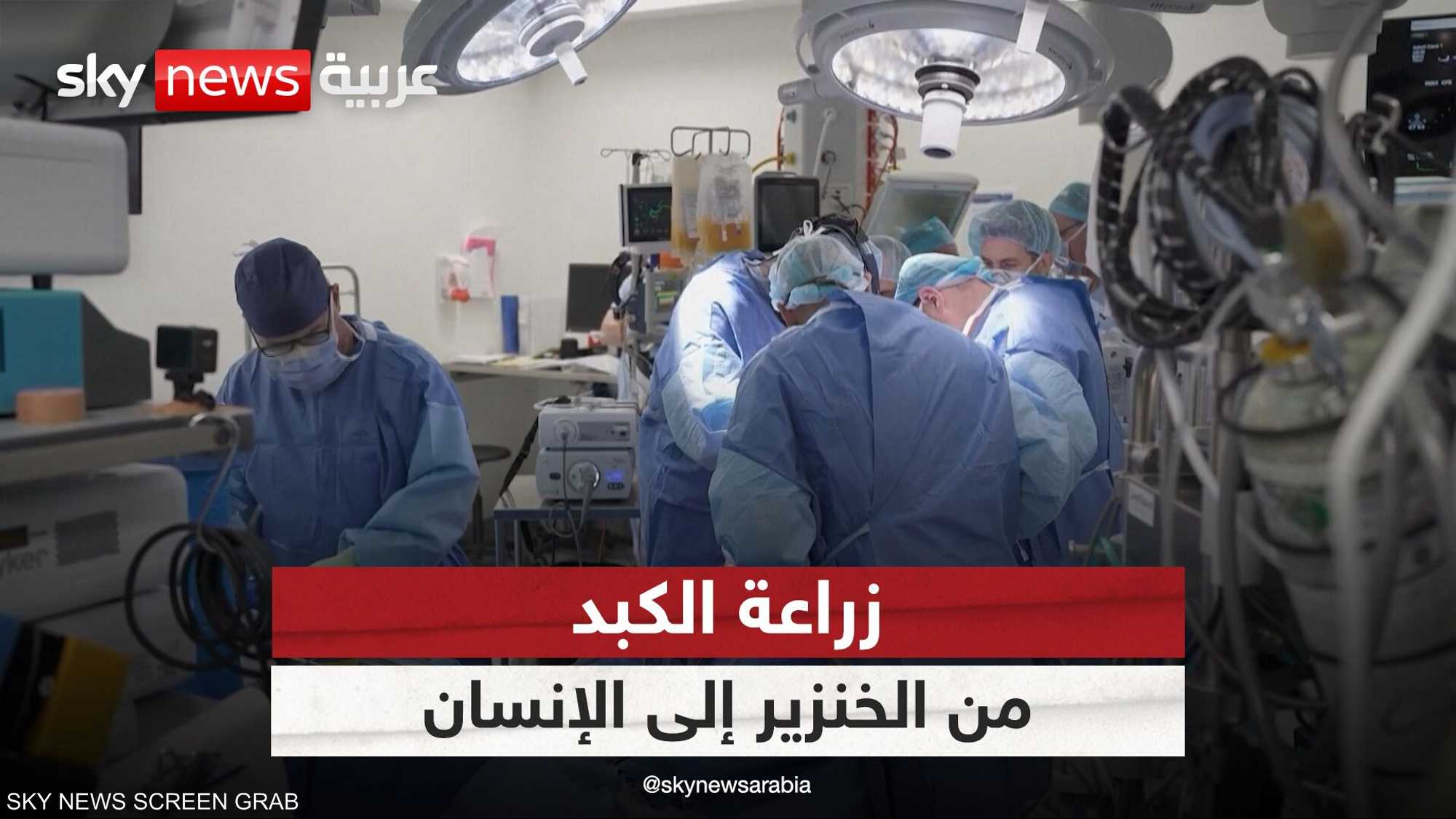 لأول مرة في العالم.. زراعة كبد خنزير في جسم إنسان - زراعة كبد خنزير