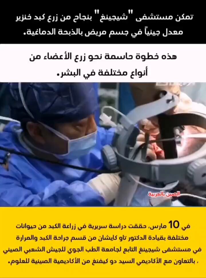 لأول مرة في العالم.. زراعة كبد خنزير في جسم إنسان - زراعة كبد خنزير