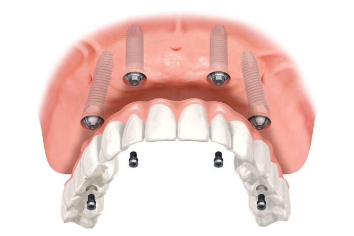 تقنية زراعة الأسنان بالليزر تقنية جديدة لتحديد وإزالة نصائح