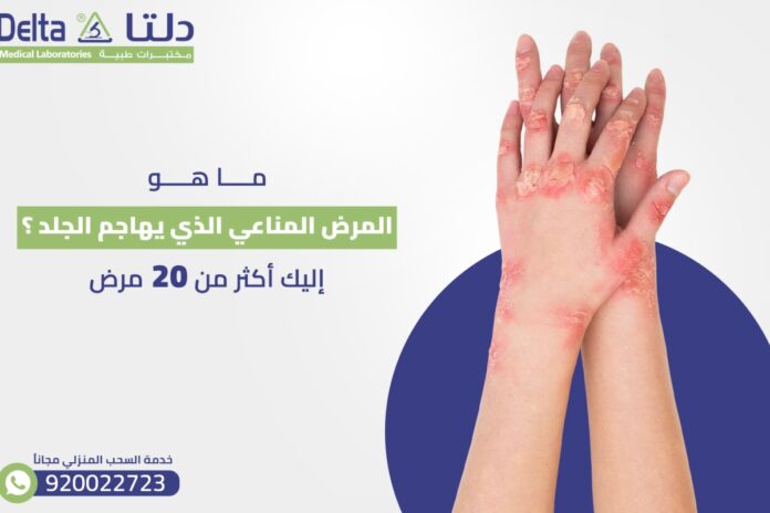 علاج مناعي لمرض التصلّب الإمارات تطور علاجا مناعيا لمرض