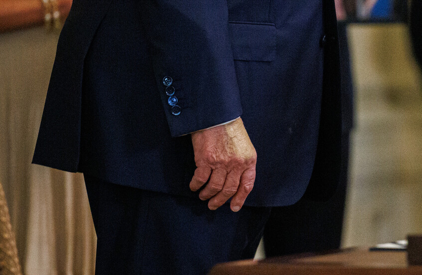 ترامب كدمات يده ترامب يكسّر صمته بشأن سبب ظهور كدمات على يده - ترامب كدمات يده