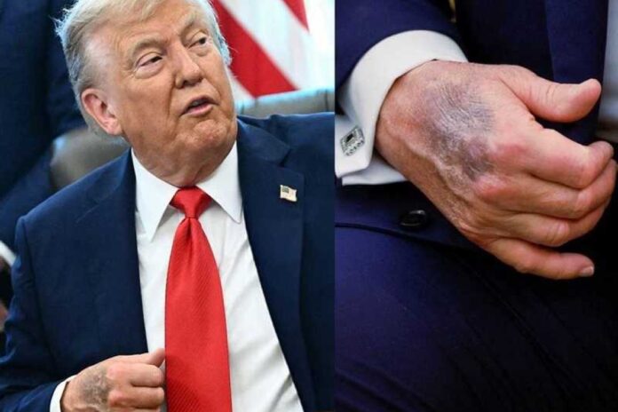 ترامب كدمات يده ترامب يكسّر صمته بشأن سبب ظهور كدمات على يده