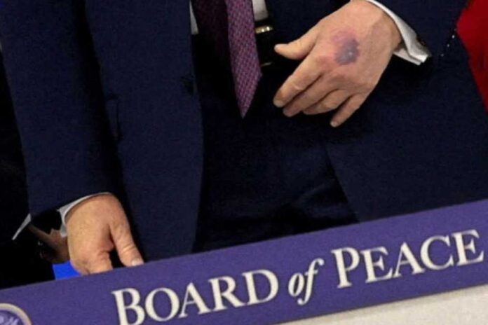 كدمة ترامب: هل هي نتيجة مصافحة أم حادث طاولة؟